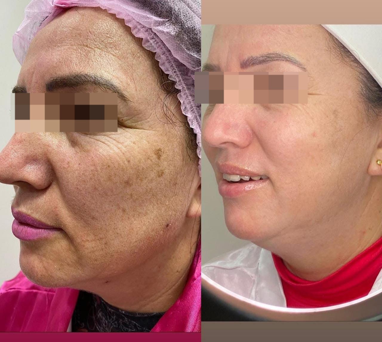 Resultado Harmonização Linhas de Marionete